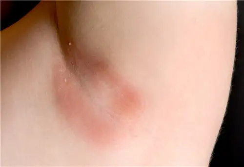 頭孢過敏紅疹能自愈嗎